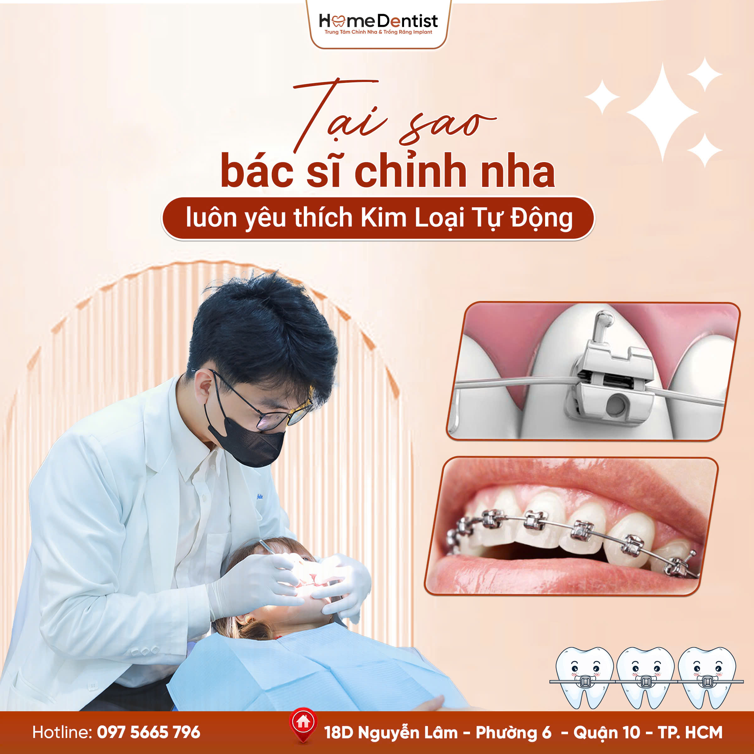 Kim loại tự động luôn được bác sĩ chỉnh nha yêu thích nhất