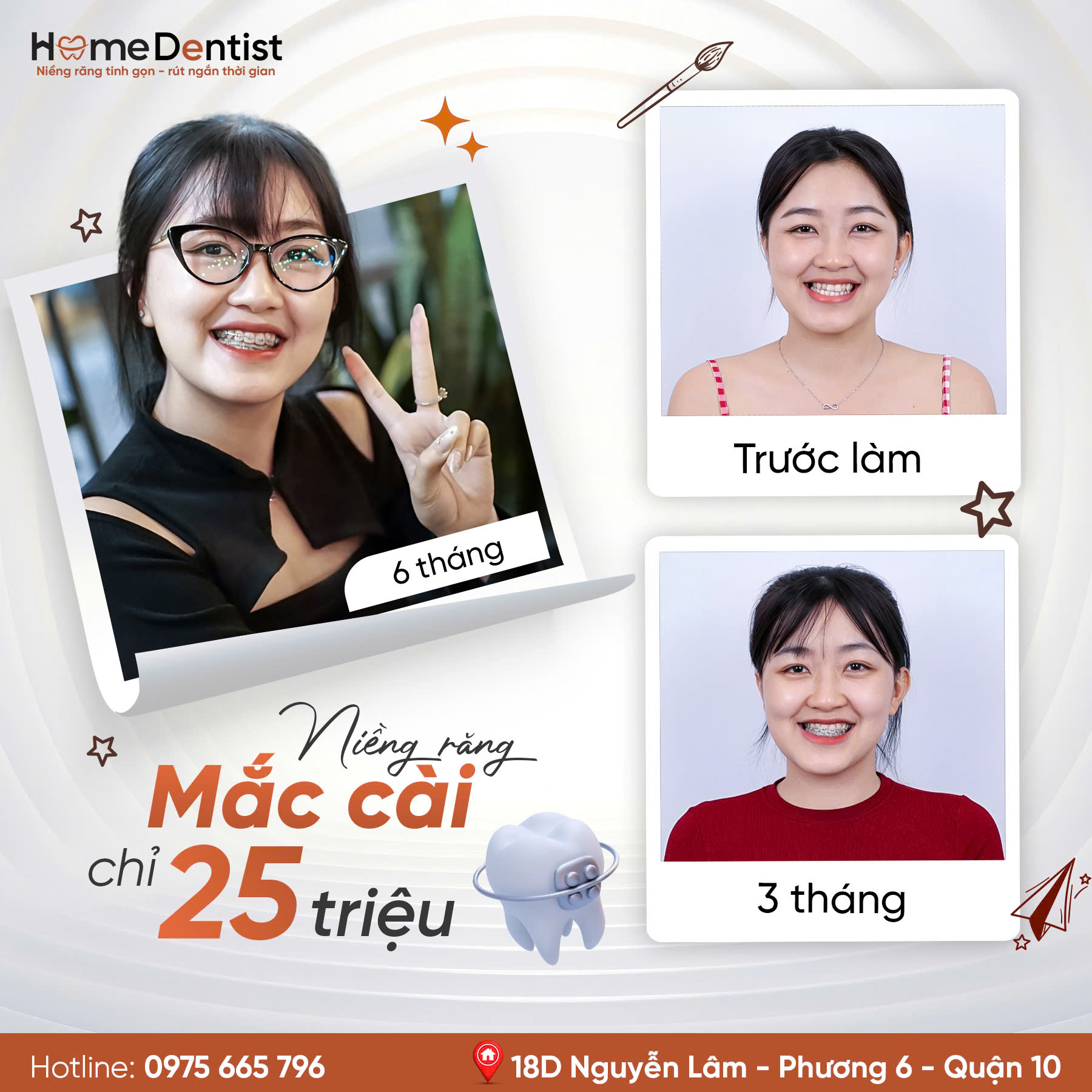 Thay đồi chỉ sau 6 tháng niềng răng mắc cài AO